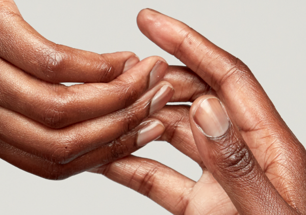 What is Contact Dermatitis?